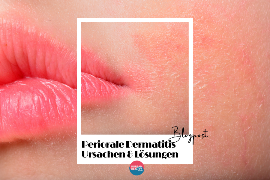 Periorale Dermatitis – Ursachen und Lösungen